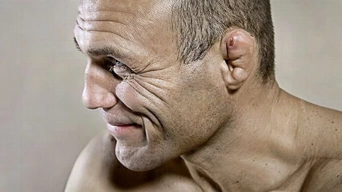 Man with cauliflower ear